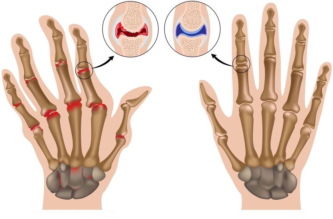 Hondrolife restores joints