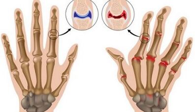 The main differences in arthritis and arthrosis