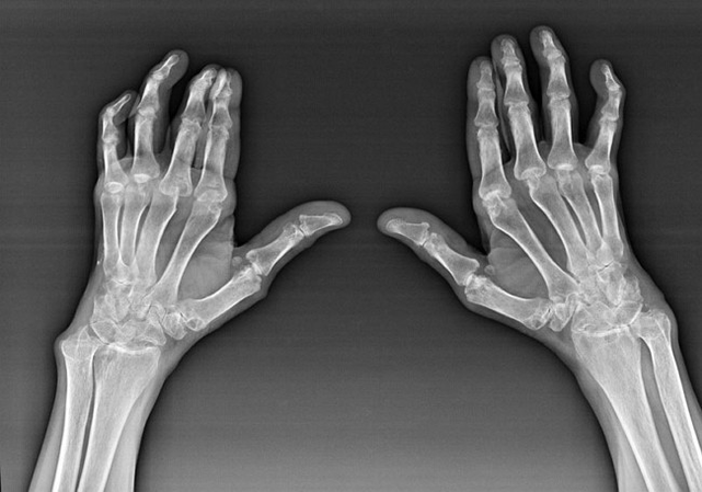 Diagnosis of the joints of the fingers