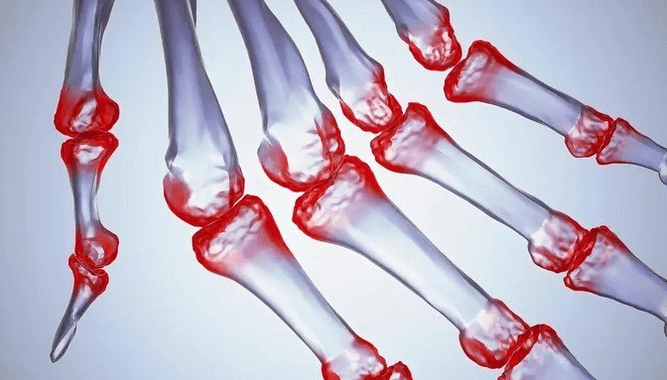 Pain in the joints of the fingers