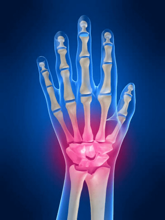 Wrist arthritis