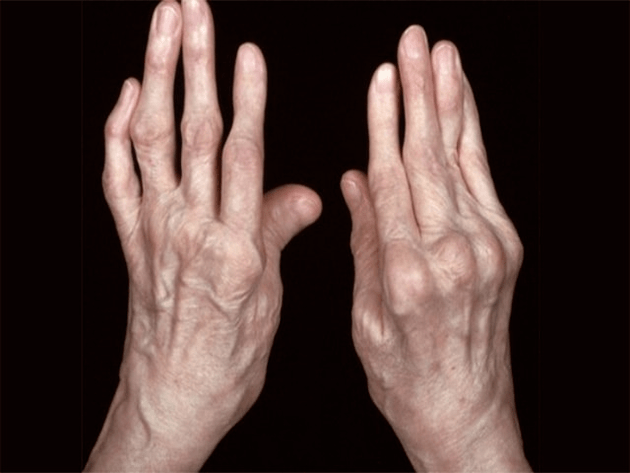 arthritis as a cause of pain in the joints of the fingers