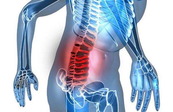 Deformation of the spine in the fourth stage of lumbar osteochondrosis