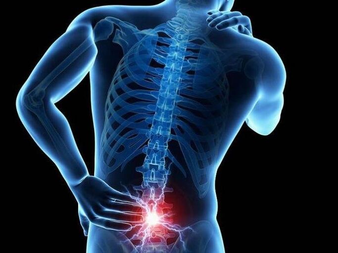 In radiculitis, pinched nerve roots provoke the appearance of sharp pain in the lower back