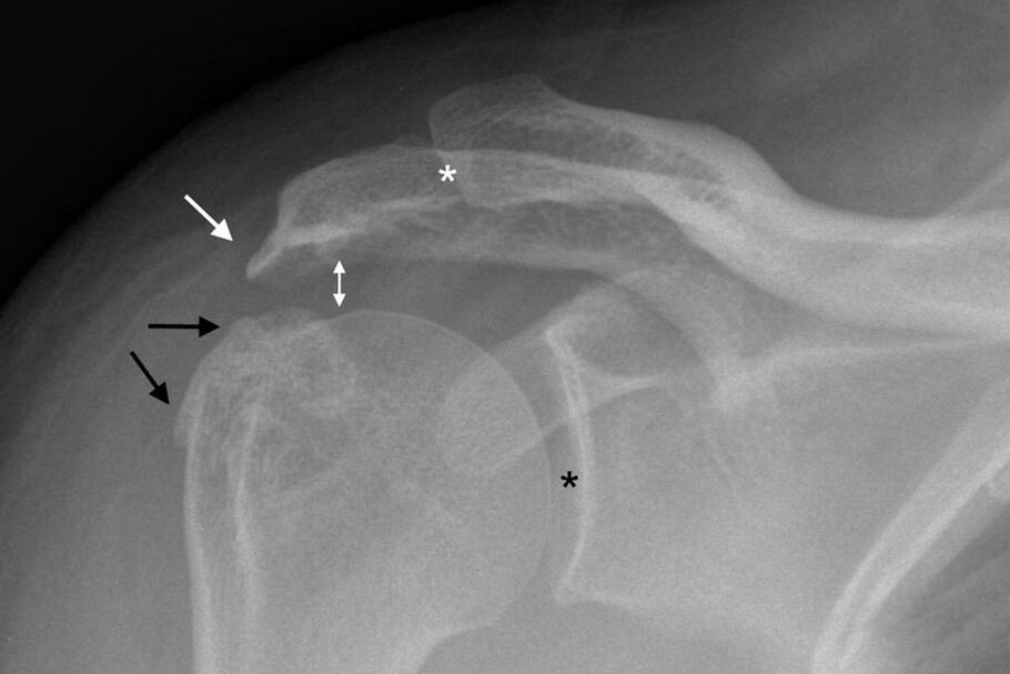arthrosis of the shoulder joint on an X-ray