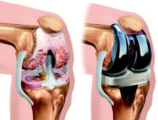 Arthroplasty is a surgical method of treatment in which the affected joint is replaced with a prosthesis.