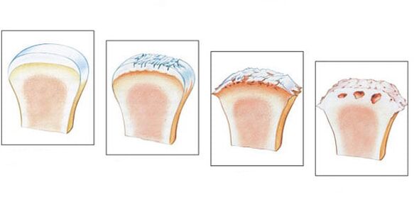 Healthy joint and 3rd degree of arthrosis development