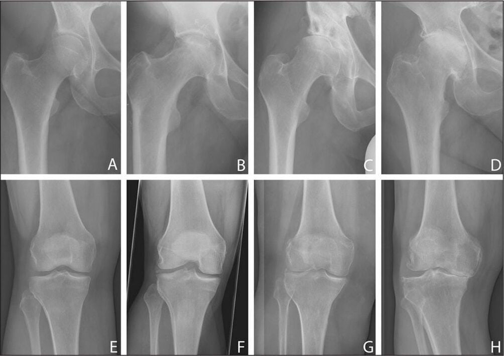 Stages of development of joint arthrosis on X-ray